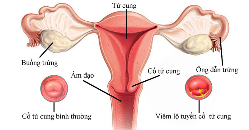 Viêm lộ tuyến cổ tử cung là tình trạng lớp tế bào biểu mô tuyến bộc lộ ra ngoài và bị nhiễm trùng