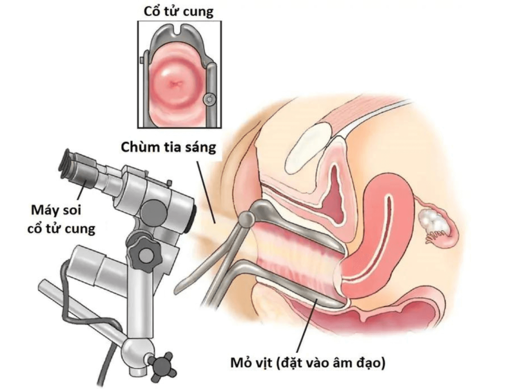 Máy soi tử cung giúp phát hiện những tổn thương khó quan sát bằng mắt thường