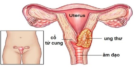 HPV là một trong những nguyên nhân chính gây ra tình trạng ung thư cổ tử cung