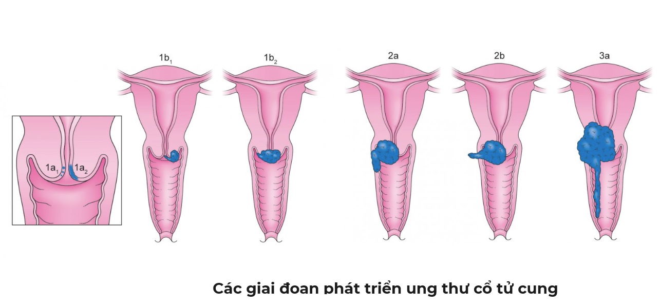 Các giai đoạn ung thư cổ tử cung