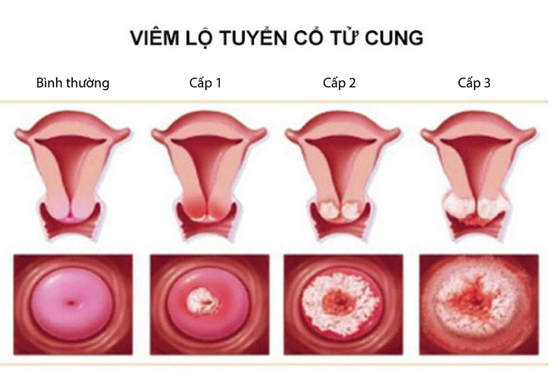 Viêm lộ tuyến cổ tử cung độ 3 là giai đoạn nặng nhất, luôn có nguy cơ cao lây lan sang các bộ phận khác.