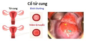 Vệ sinh sau khi đốt viêm lộ tuyến cần lưu ý gì?