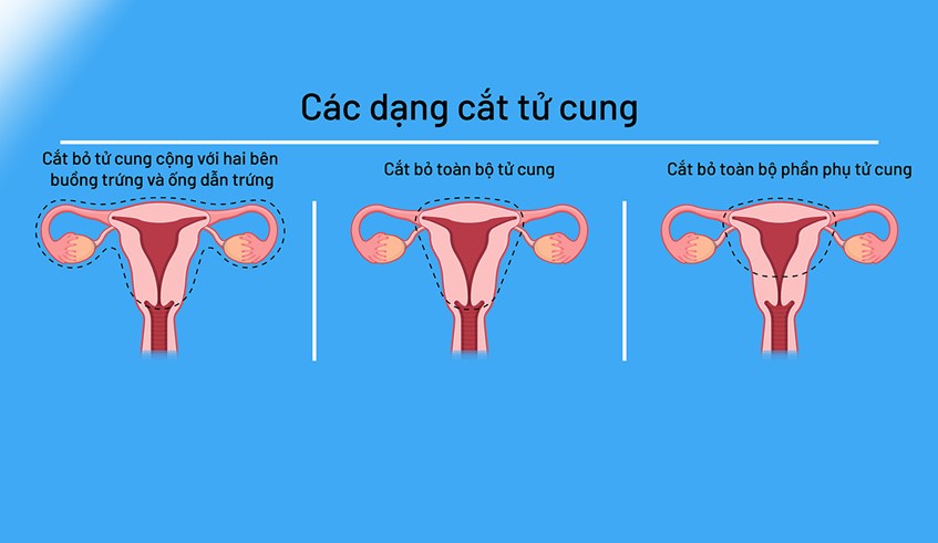 cac dang cat bo tu cung