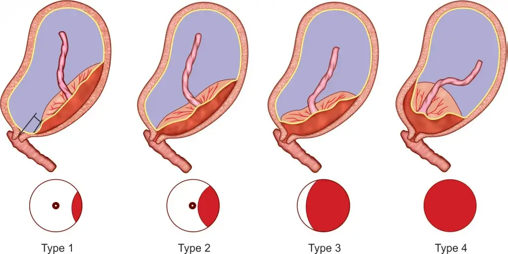 Các thể rau tiền đạo