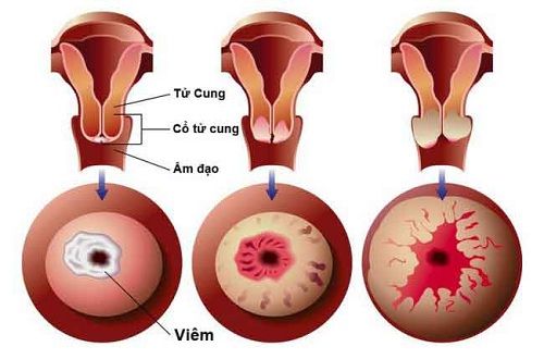 Các mức độ viêm lộ tuyến cổ tử cung.