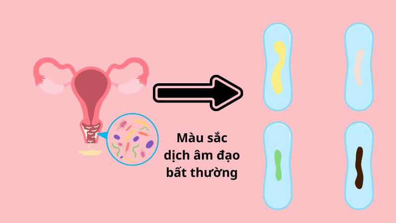 Dịch âm đạo trở về bình thường là dấu hiệu người bệnh khỏi bệnh viêm lộ tuyến