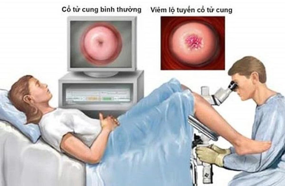     Đốt điện cổ tử cung nên được thực hiện bởi bác sĩ có tay nghề để tránh để lại biến chứng