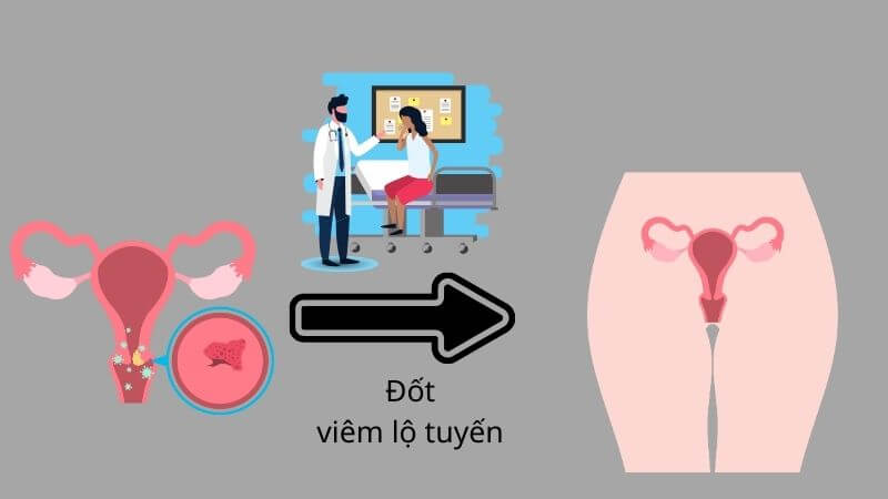 Thời gian hồi phục sau đốt viêm lộ tuyến là vấn đề được nhiều chị em quan tâm