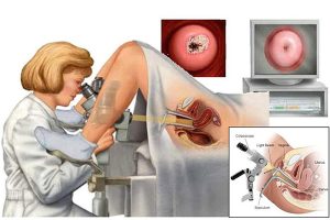 Đốt viêm lộ tuyến cổ tử cung là phương pháp được sử dụng rộng rãi hiện nay