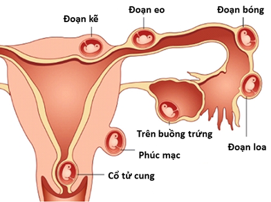 Nguy cơ chửa ngoài tử cung khi viêm lộ tuyến độ 3.