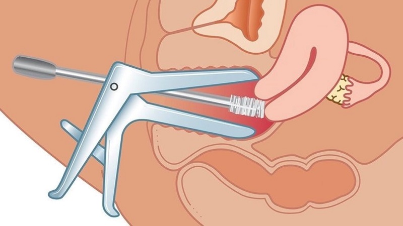 Khám mỏ vịt không phải là nguyên nhân gây chảy máu sau khi khám phụ khoa