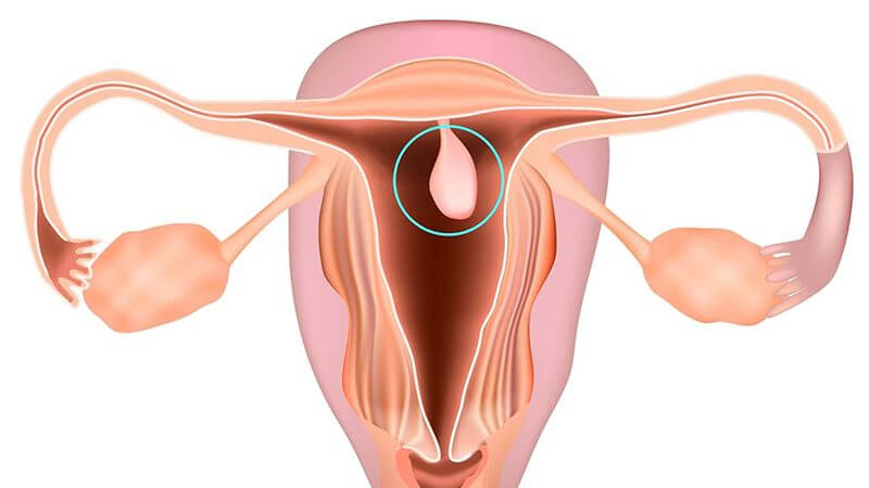 Polyp cổ tử cung có thể làm xuất hiện tình trạng khí hư ra nhiều loãng như nước