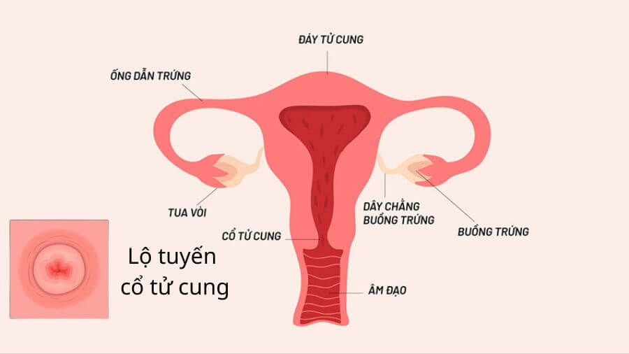 Các tế bào tuyến phát triển ra phía ngoài cổ tử cung gây ra tình trạng lộ tuyến