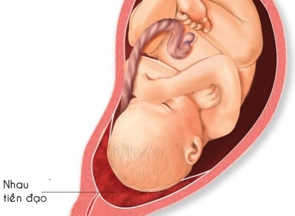 4. Các phương pháp chẩn đoán và phân loại rau tiền đạo