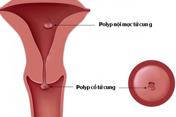 Polyp cổ tử cung có thể hiểu đơn giản là một cục thịt thừa tại vị trí cổ tử cung