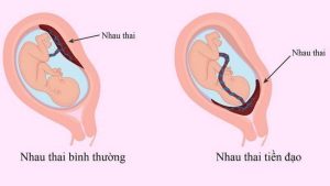 Rau tiền đạo: Nguyên nhân, dấu hiệu và cách phòng ngừa