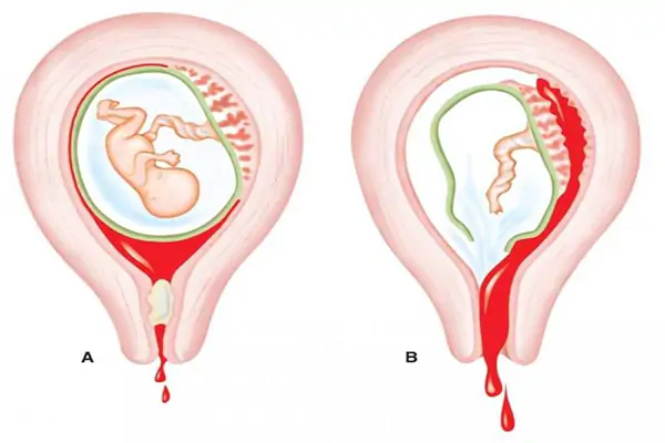 Rau tiền đạo gây chảy máu trong quý cuối thai kỳ.