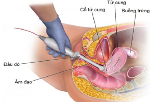 Vị trí đặt đầu dò trong siêu âm đầu dò qua đường âm đạo