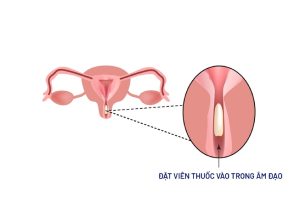 Đặt thuốc viêm lộ tuyến ra máu nâu