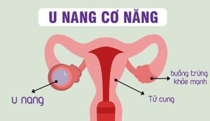 U nang buồng trứng: Nguyên nhân, triệu chứng và điều trị