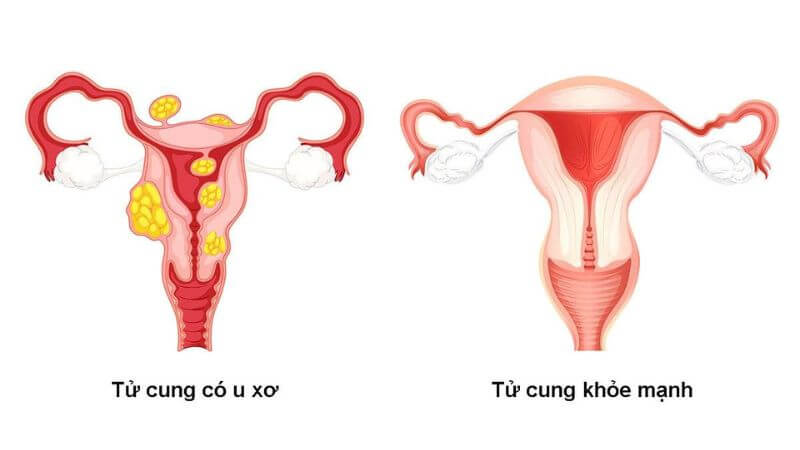 U xơ tử cung là khối u tồn tại ở cơ tử cung