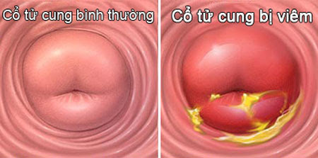 Viêm cổ tử cung.