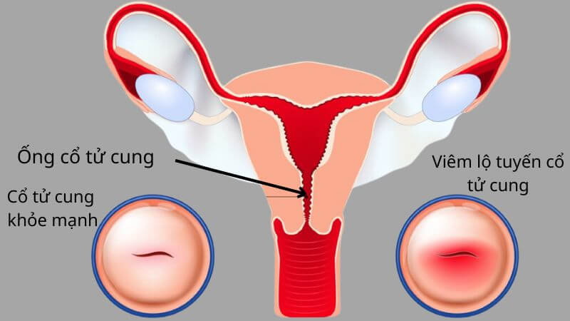 Viêm lộ tuyến cổ tử cung là tình trạng các tế bào tuyến phát triển và xâm lấn ra bên ngoài