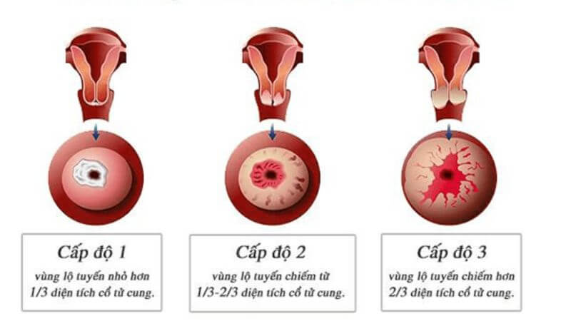 Tình trạng lộ tuyến cổ tử cung chia thành 3 cấp độ