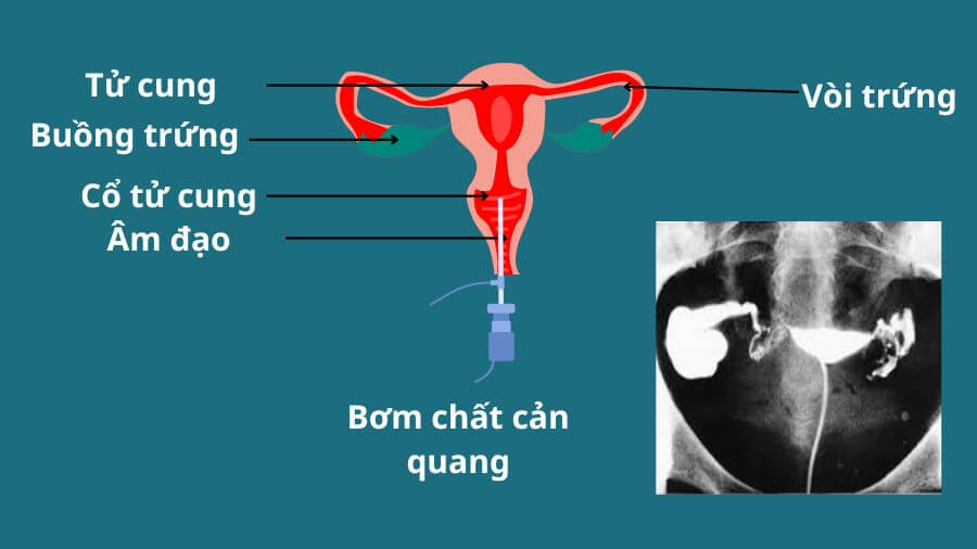 Chụp X-quang tử cung vòi trứng nhằm phát hiện những bất thường của tử cung và vòi trứng