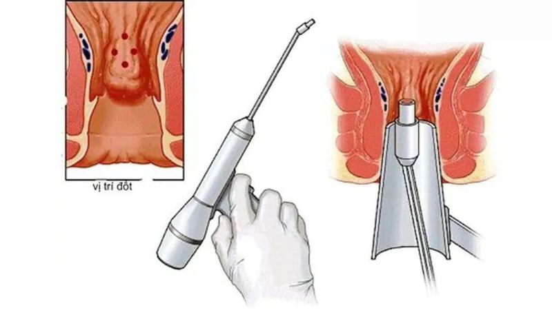 Điều trị đốt viêm lộ tuyến cổ tử cung và tuân thủ điều trị sau đốt là cần thiết.