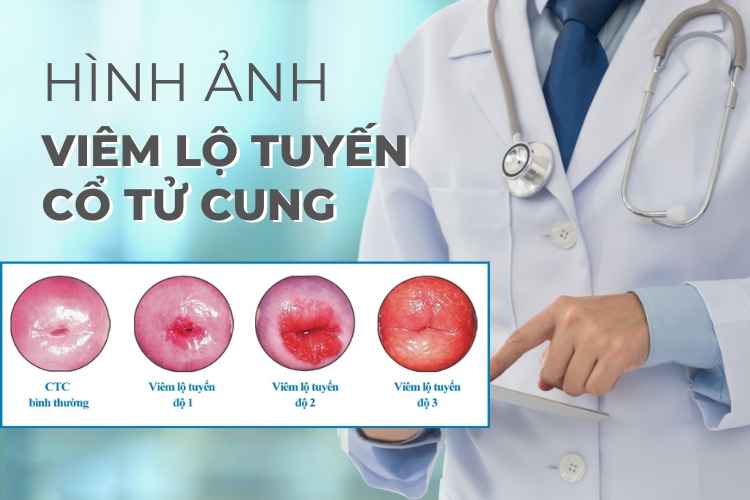 Viêm lộ tuyến cổ tử cung là bệnh phụ khoa phổ biến ở độ tuổi sinh sản của chị em