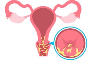 Bị lộ tuyến cổ tử cung và nhiễm HPV nguy hiểm không?