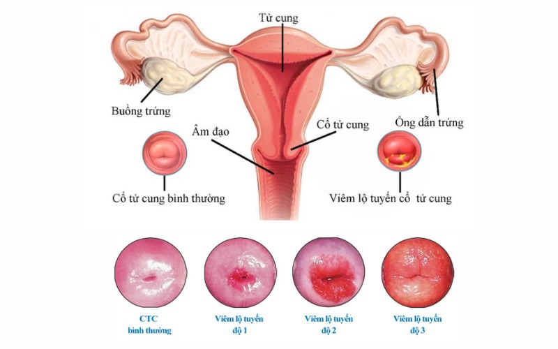 Viêm lộ tuyến không nên sử dụng cốc nguyệt san dù ở giai đoạn nào