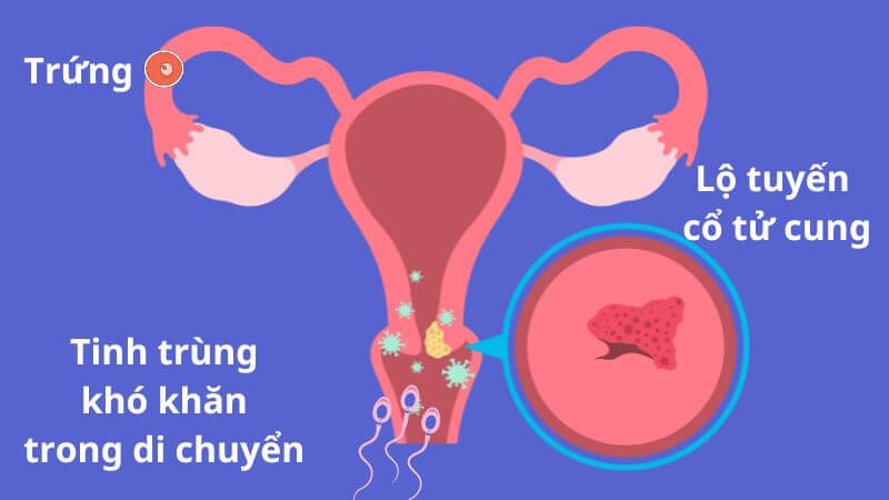 Viêm lộ tuyến cổ tử cung có thể khiến cho tinh trùng khó gặp trứng.