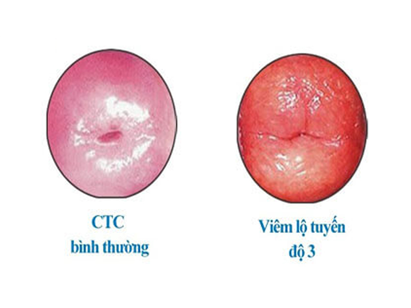 Viêm lộ tuyến cổ tử cung có nguy hiểm không ?