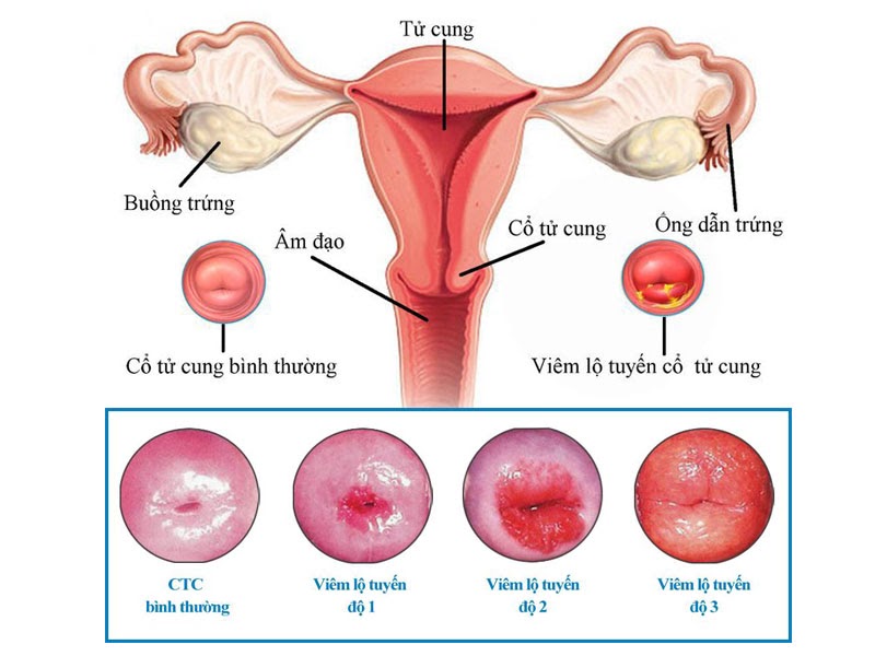 Viêm lộ tuyến độ khi mang thai có thể gây tắc cổ tử cung, sẩy thai và sinh non