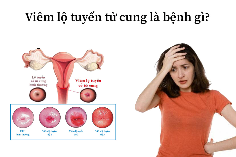 Viêm lộ tuyến cổ tử cung: Đánh giá bệnh và cách điều trị