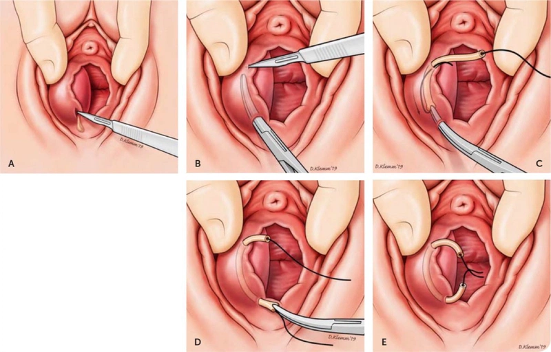 Điều trị viêm tuyến Bartholin bằng phương pháp rạch nang tuyến Bartholin.