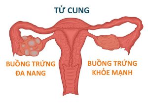 Điều trị vô sinh do đa nang buồng trứng