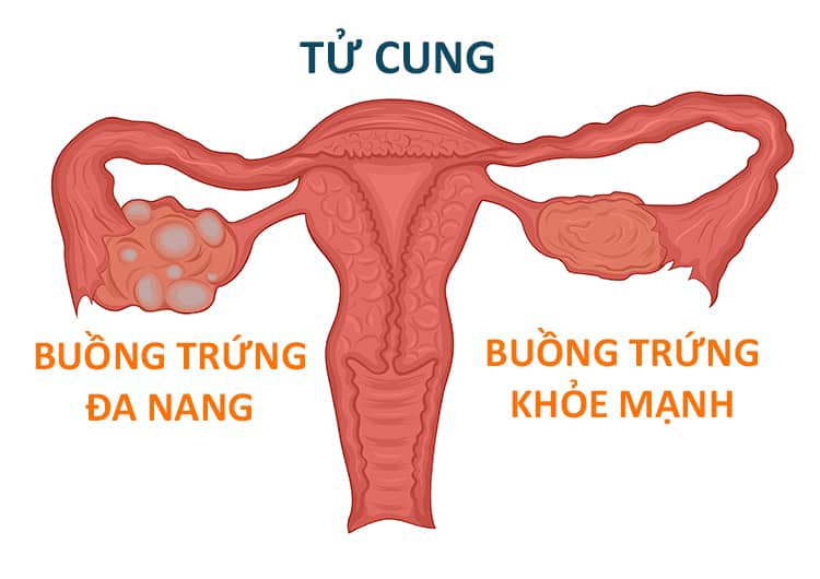 đa nang buồng trứngg là một tình trạng rối loạn nội tiết phổ biến gây vô sinh