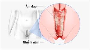 Có nên chiếu tia hồng ngoại chữa viêm phụ khoa ?