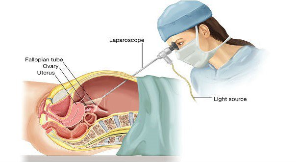 Nội soi ổ bụng chẩn đoán lạc nội mạc tử cung