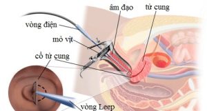 Viêm lộ tuyến cổ tử cung độ 2 có nên đốt không?