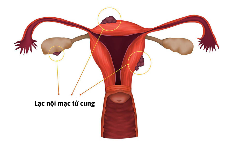 Lạc nội mạc tử cung