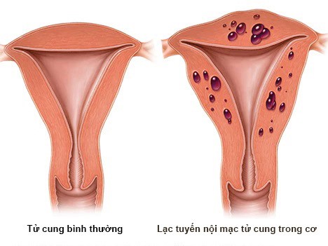 Lạc nội mạc tử cung là khi mô nội mạc tử cung có mặt ở ngoài tử cung hoặc ngay trong cơ tử cung