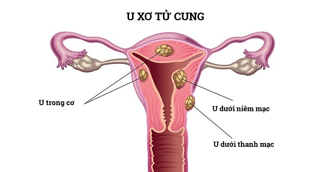 U xơ tử cung là một trong những nguyên nhân gây ra tình trạng rong kinh máu cục