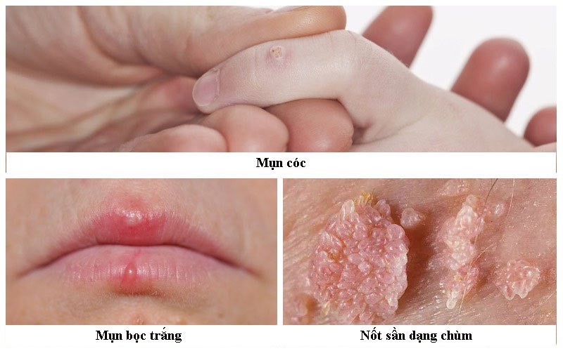 Các triệu chứng liên quan đến HPV nam giới cần để ý