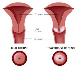 Hình ảnh minh họa ung thư cổ tử cung.