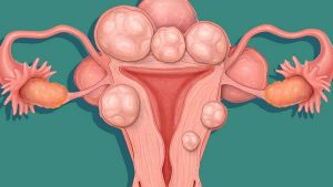 Đi khám vì rong kinh – phát hiện u xơ tử cung to cần mổ sớm