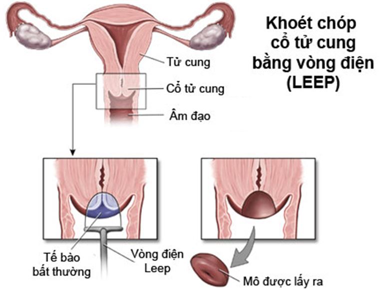 Điều trị tiền ung thư cổ tử cung